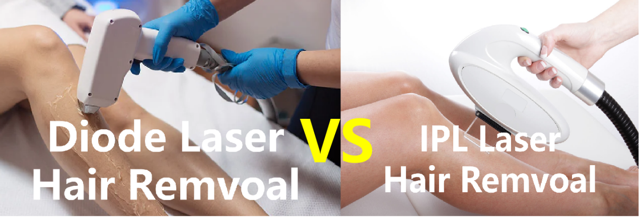 IPL VS DIODI LASER HIRVIENPOISTO