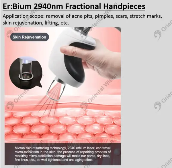 Uusi Skin Renew Expert - 2940nm Erbium Laser