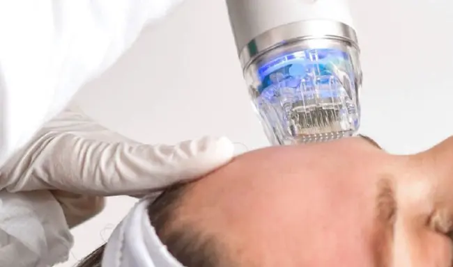 Mitä hyötyä RF-mikroneulaushoidosta on?