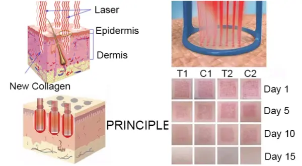 Fractional CO2 laser